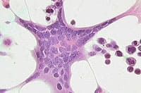 диагностика рака