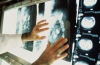 химиотерапия