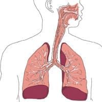 рак легких