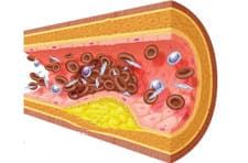 рак кишечника