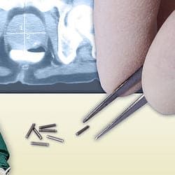 рак простаты