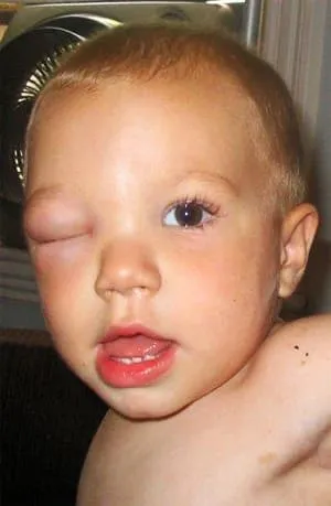 Последствия укуса шмеля в глаз ребенка