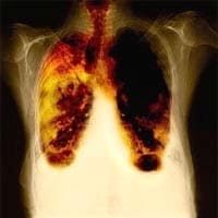 Рак легких - Народные способы лечения